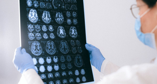Una Nuova Prospettiva sull'Alzheimer: Ricerche Recenti Rivoluzionano la Comprensione della Malattia